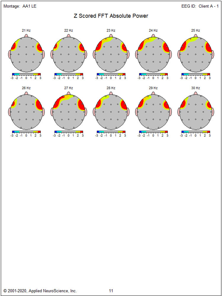 Z-scored FFT absolute power linked ears montage continued
